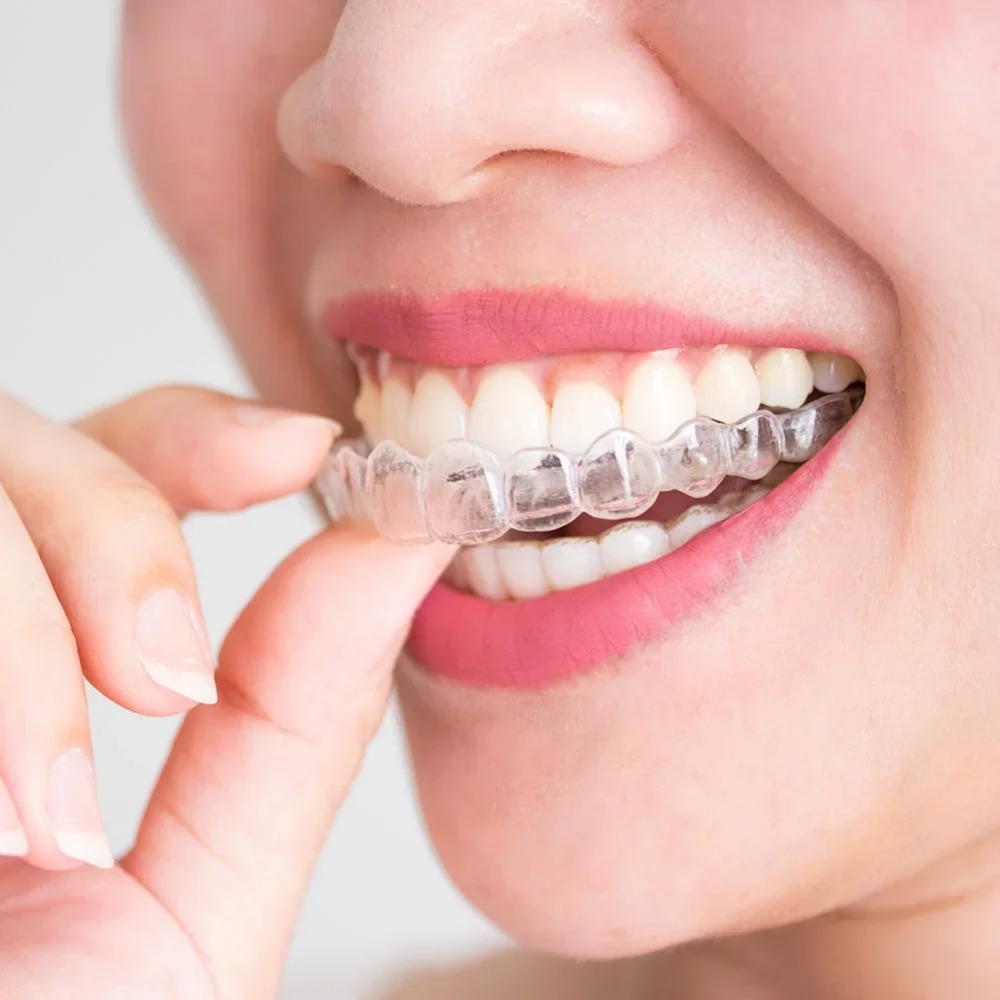 Dental Guard Night - 1-4Pc Pelindung Mulut Anti Mendengkur dan