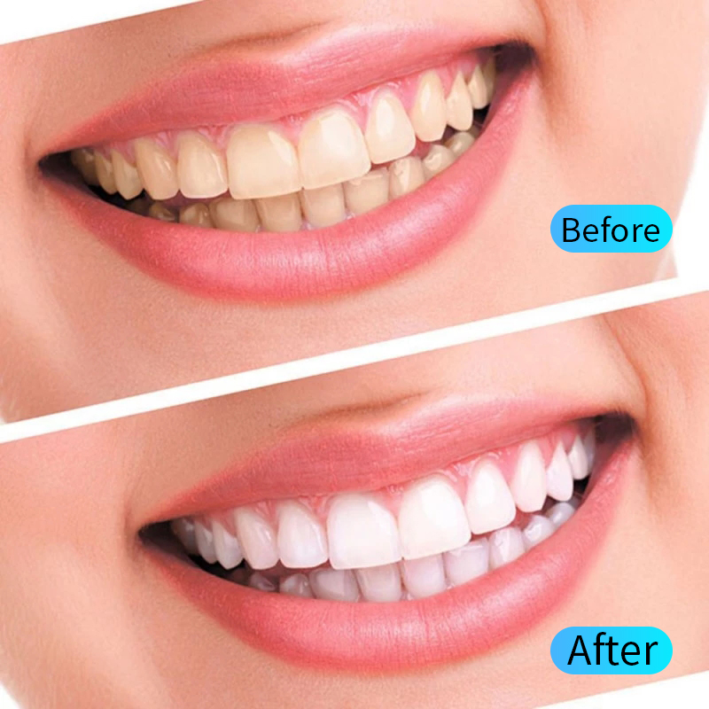 Kit Gel pemutih gigi, alat keb - Teeth Whitening Opalescence ulasan dan harga