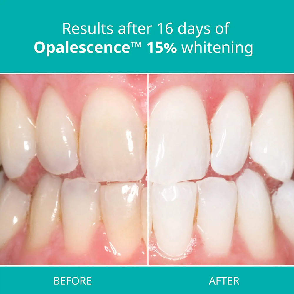 Kit Pemutih Profesional Opales - Teeth Whitening Opalescence ulasan dan harga