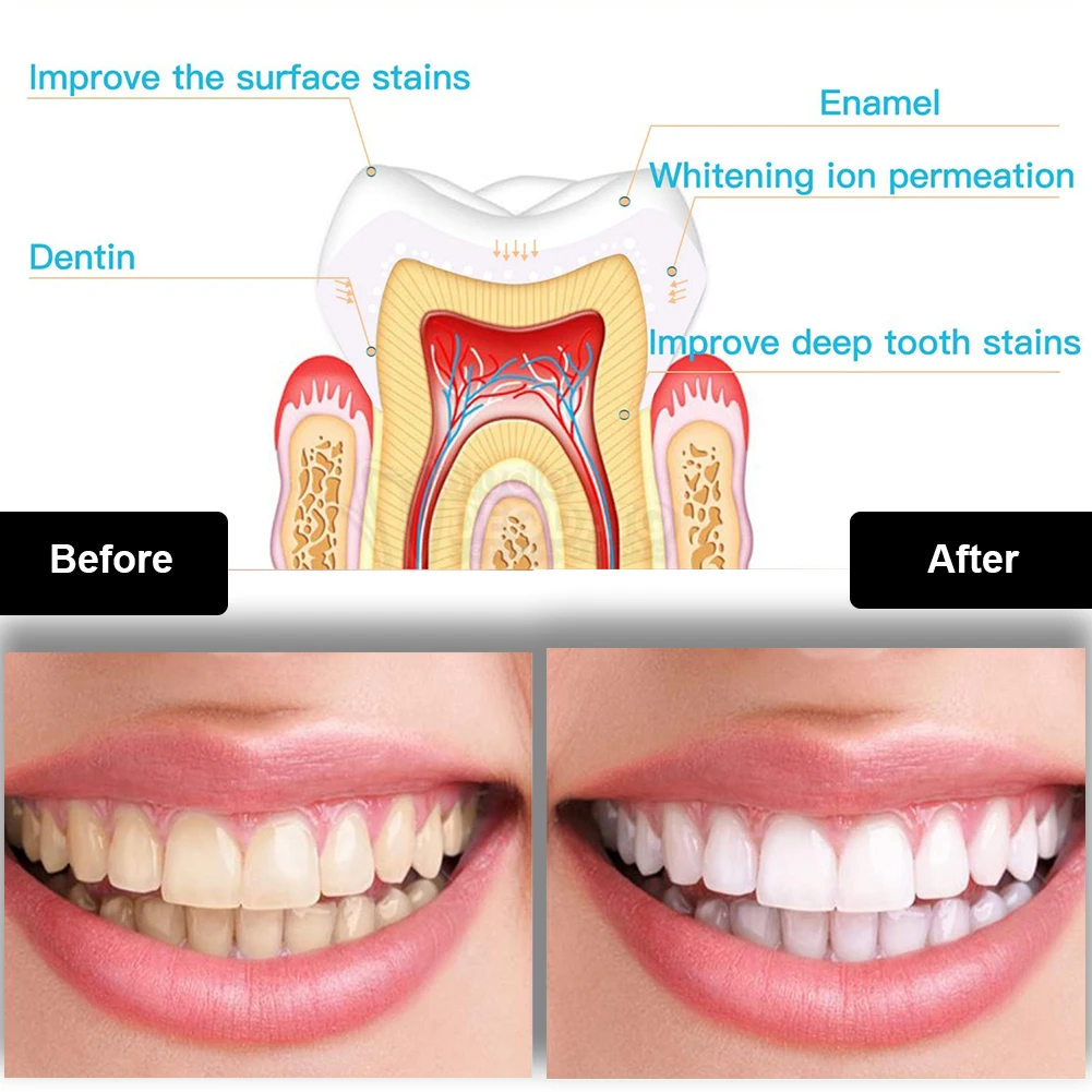 Kit pemutih gigi Mini 16 LED c - Teeth Whitening Opalescence ulasan dan harga