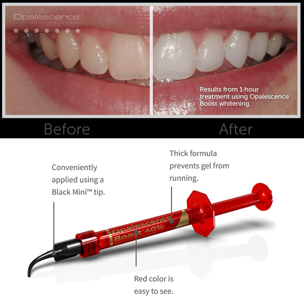 Gel Pemutih Gigi Ultradent Opa - Teeth Whitening Opalescence ulasan dan harga